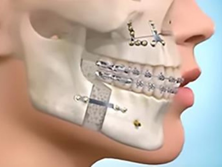 Cirurgia Ortognática - CIROOH OdontologiaFilosofia CIROOH Odontologia - Estética e Funcional
